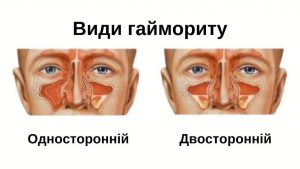 Як зрозуміти що в тебе гайморит: детальний гід із самоперевірки
